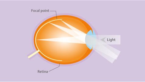 Optical treatment of myopia