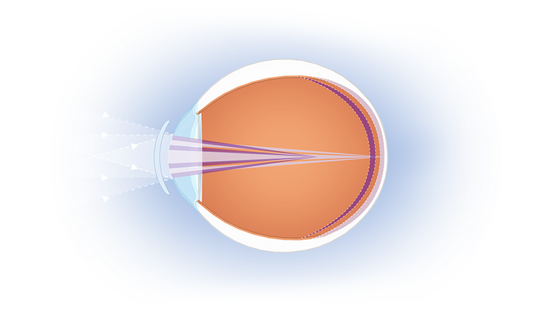 myopia progression
