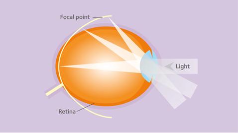 correction of myopia