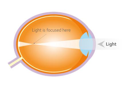 Myopic eye Myopic Eye