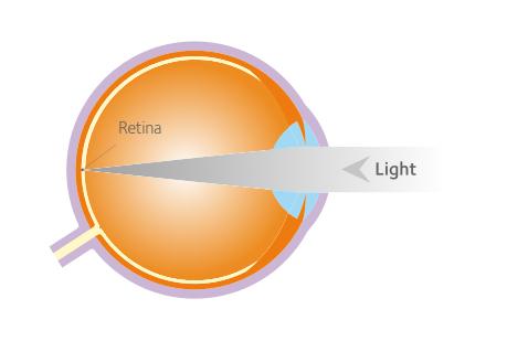 correction of myopia